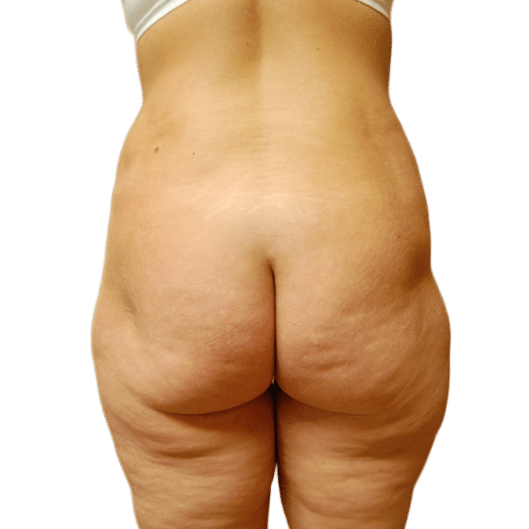 Before Image: Butt Lift - back