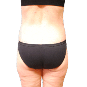 After Image: Butt Lift