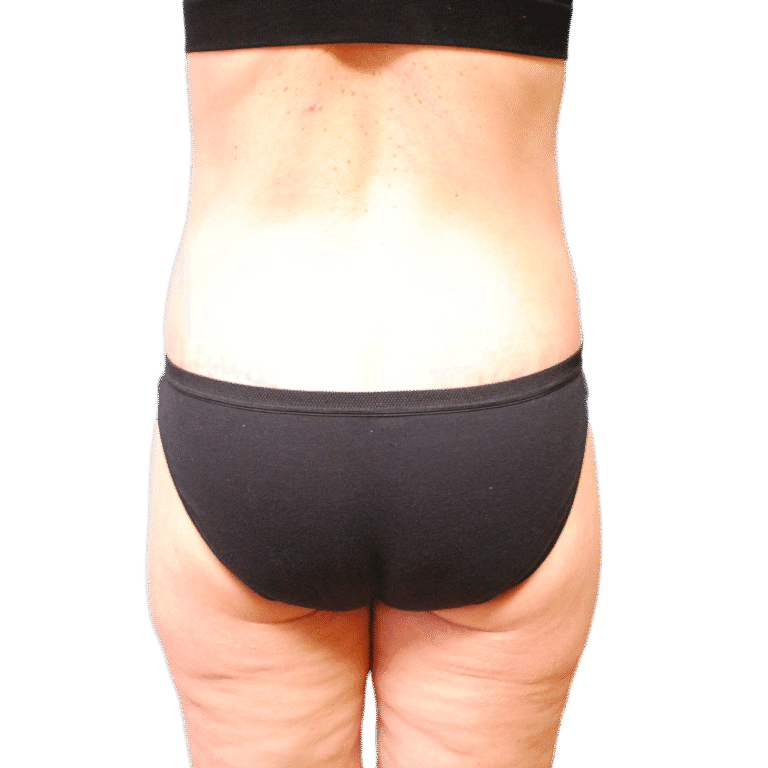 After Image: Butt Lift - back