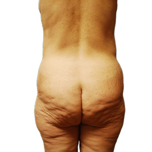 Before Image: Butt Lift