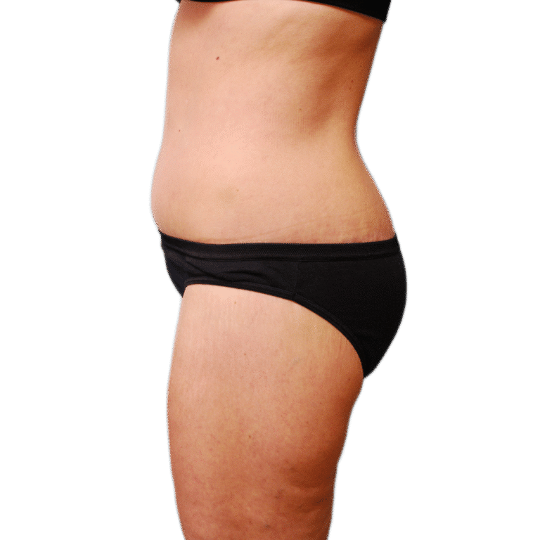 After Image: Butt Lift - left-side