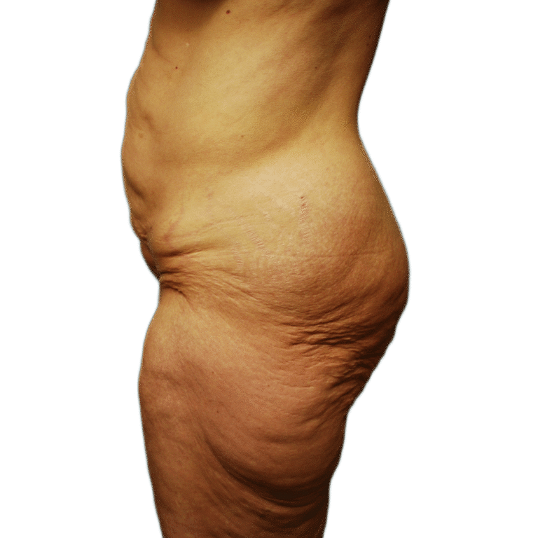 Before Image: Butt Lift - left-side