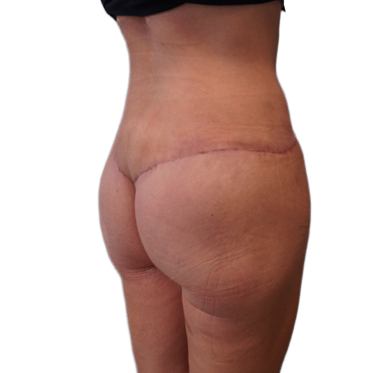 After Image: Butt Lift - right-back-oblique