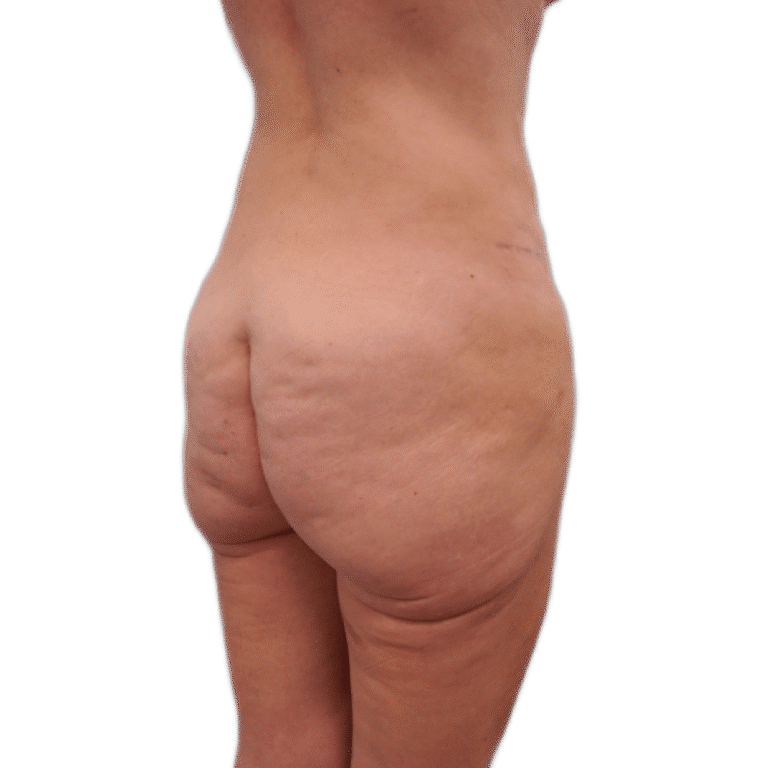 Before Image: Butt Lift - right-back-oblique