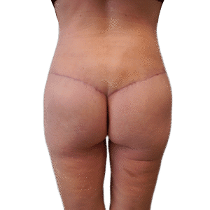 After Image: Butt Lift