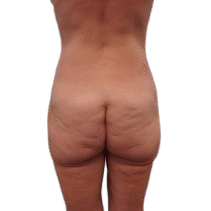 Before Image: Butt Lift