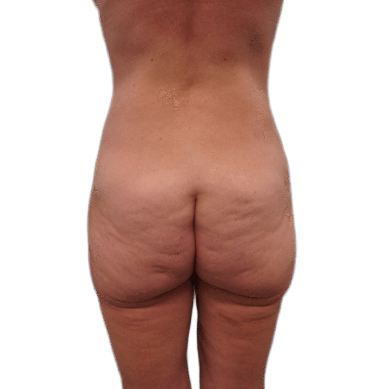 Before Image: Butt Lift - back