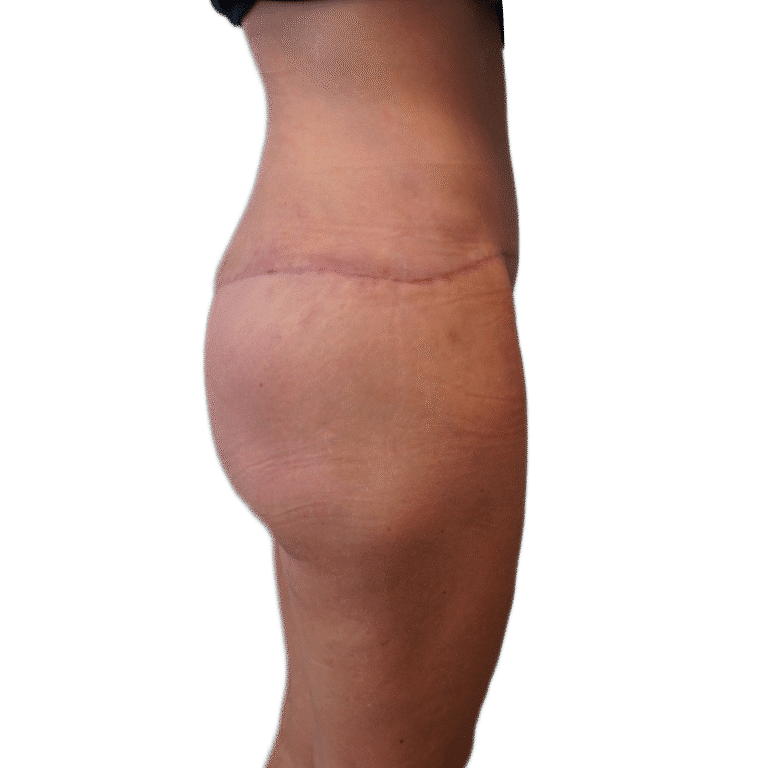 After Image: Butt Lift - right-side