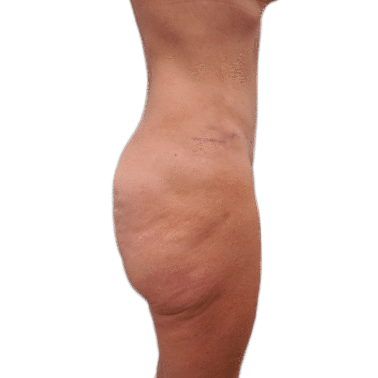 Before Image: Butt Lift - right-side