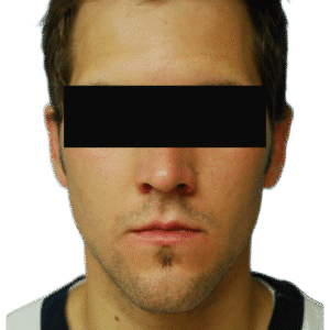 After Image: Otoplasty (ears)