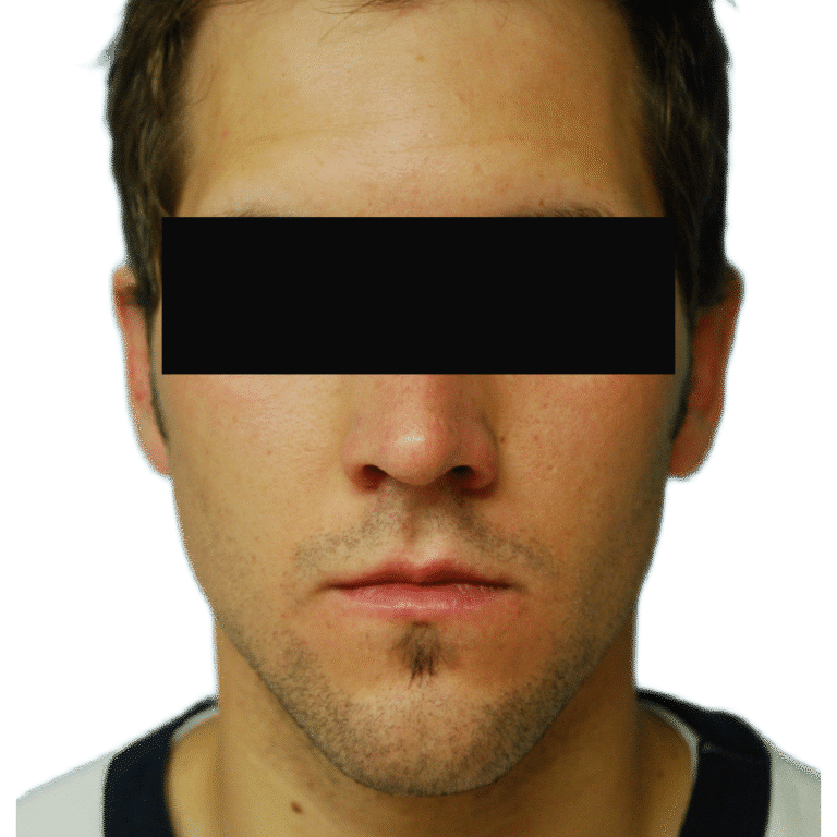 After Image: Otoplasty (ears) - front