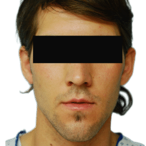 Before Image: Otoplasty (ears)