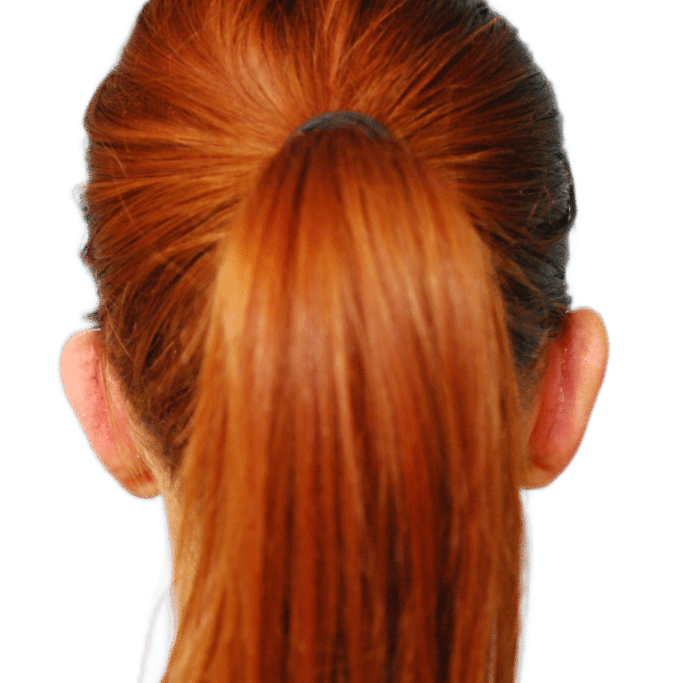 After Image: Otoplasty (ears) - back