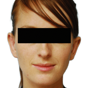 After Image: Otoplasty (ears)