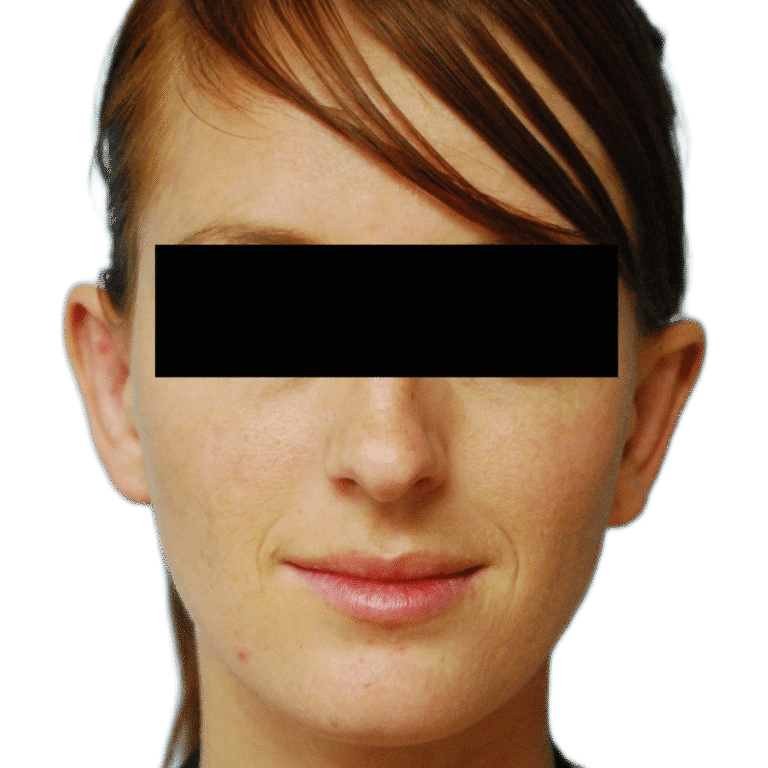 After Image: Otoplasty (ears) - front