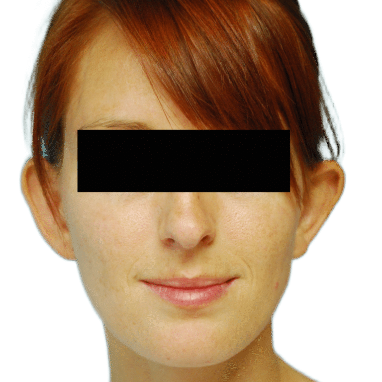 Before Image: Otoplasty (ears) - front