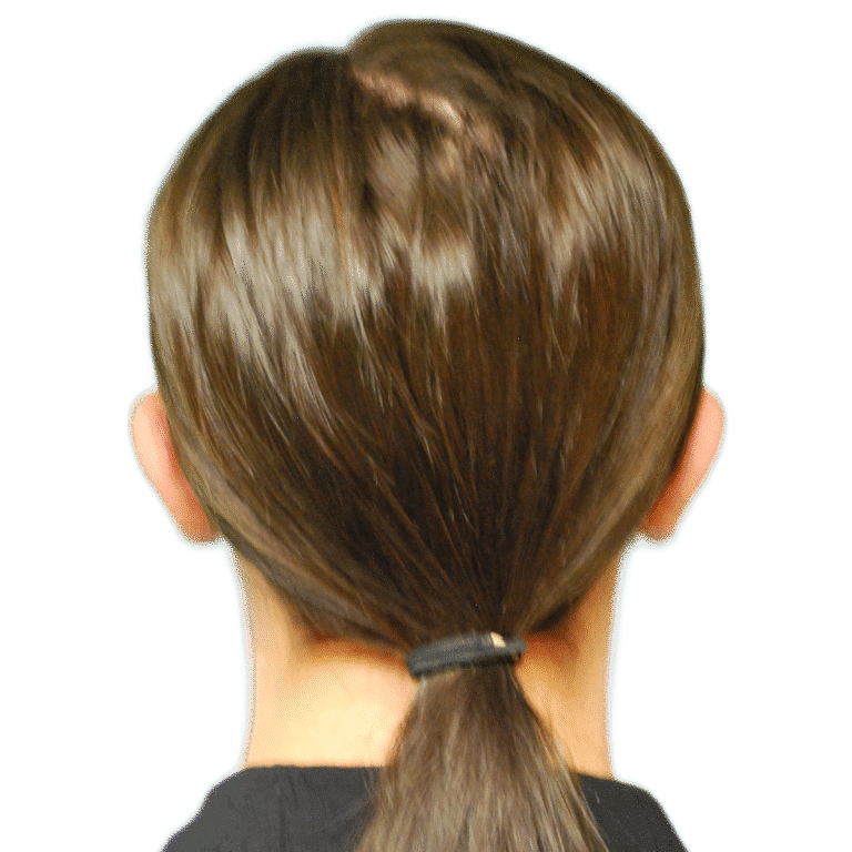 After Image: Otoplasty (ears) - back