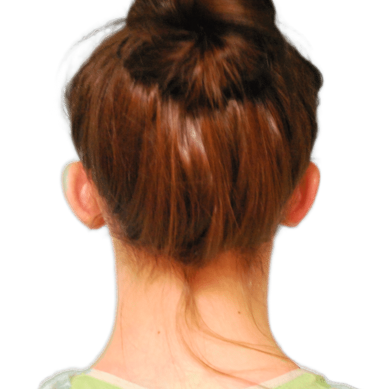 Before Image: Otoplasty (ears) - back