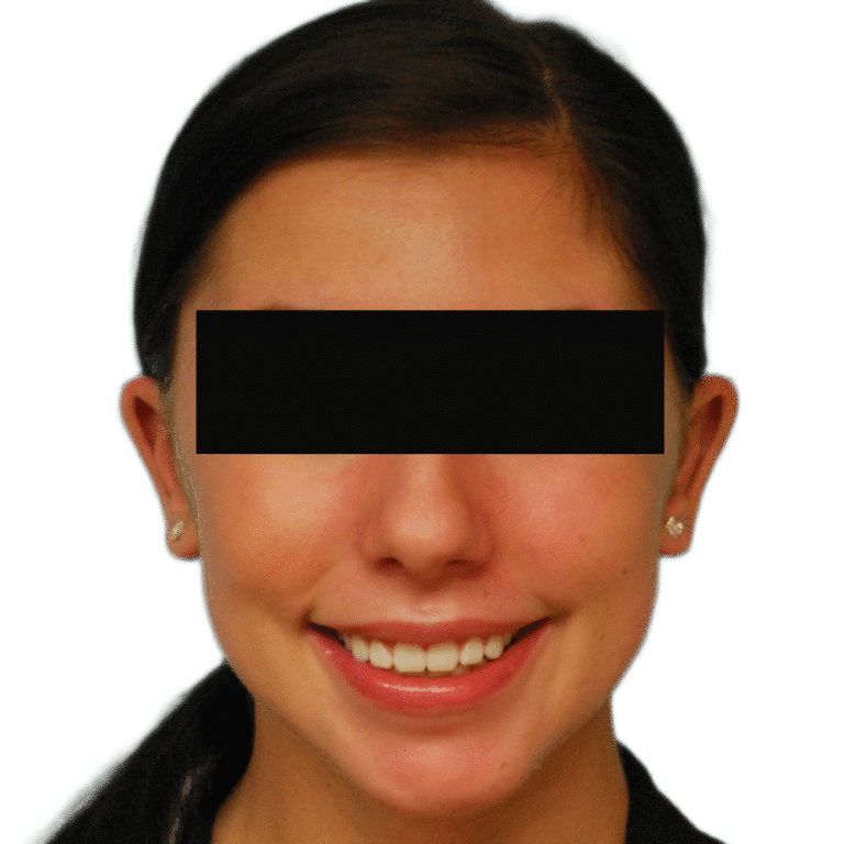 After Image: Otoplasty (ears) - front