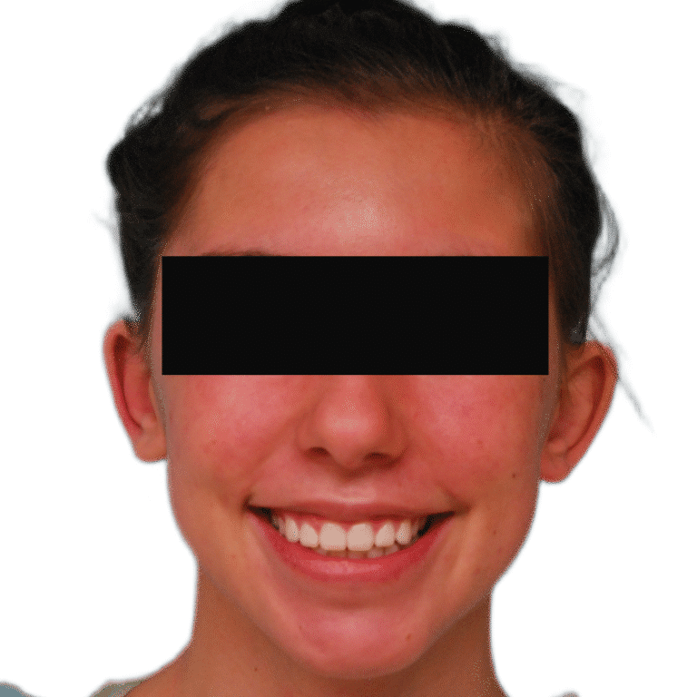 Before Image: Otoplasty (ears) - front