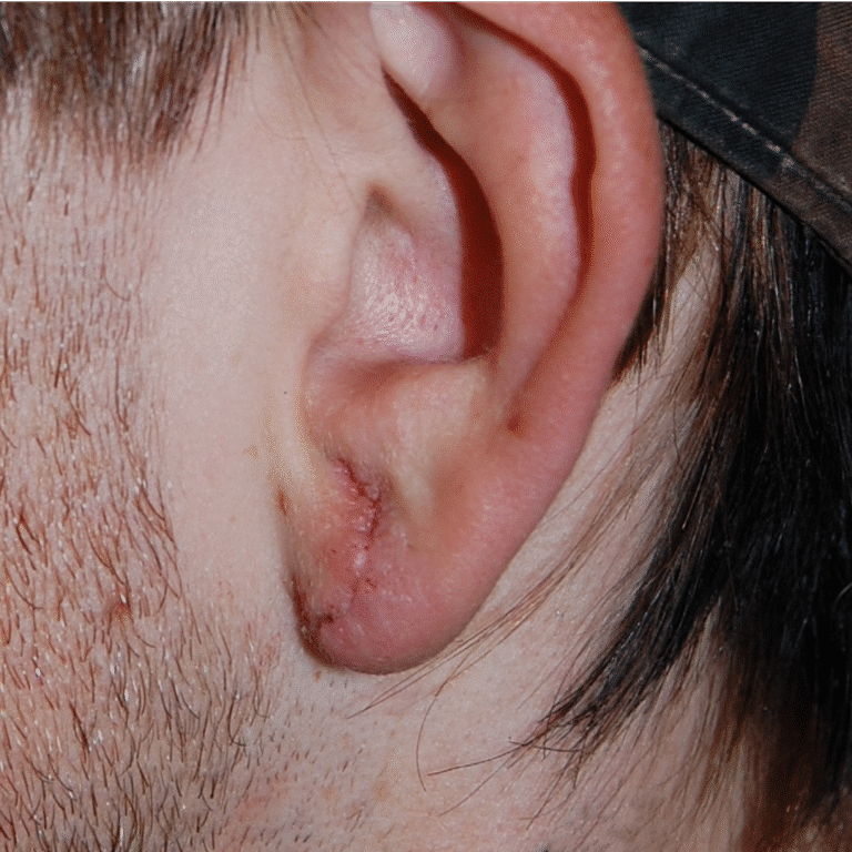 After Image: Gauged Ear Repair - left-side