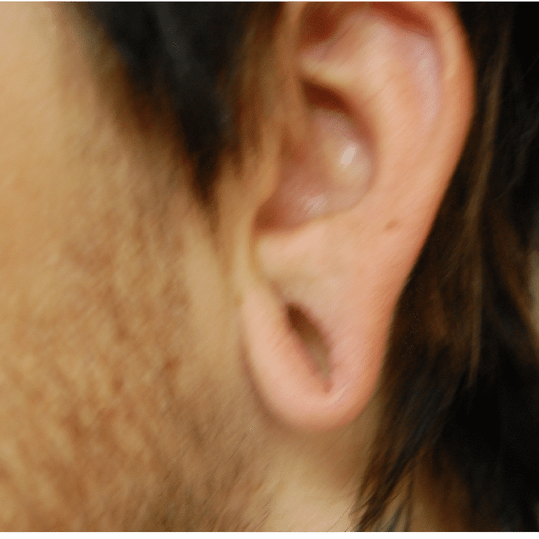 Before Image: Gauged Ear Repair - left-side