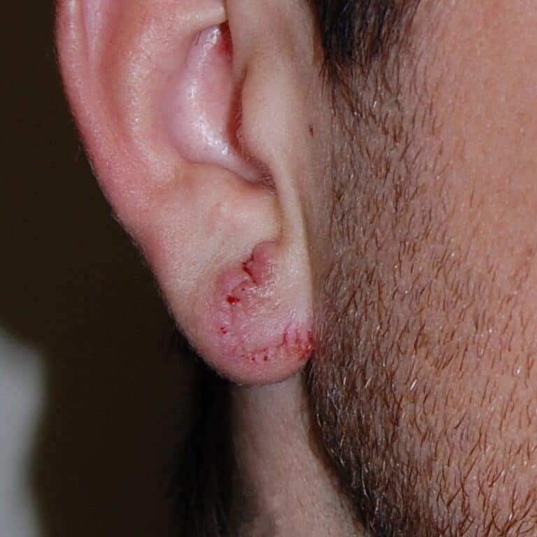 After Image: Gauged Ear Repair - right-side