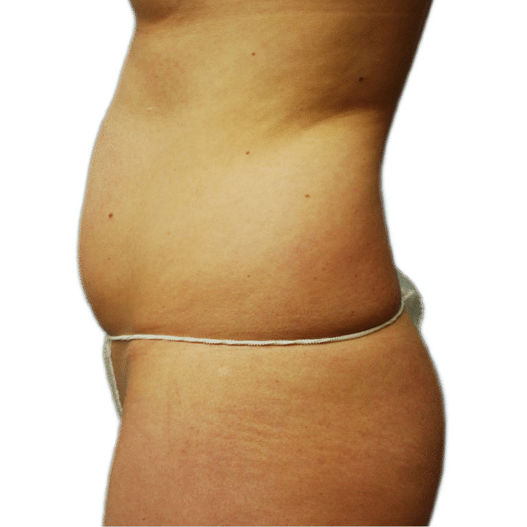 Before Image: Fat Grafting to Breast with Liposuction - left-side