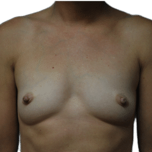 Before Image: Fat Grafting to Breast with Liposuction