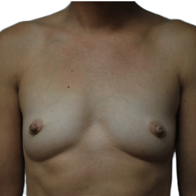 Before Image: Fat Grafting to Breast with Liposuction - front