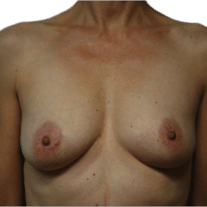 After Image: Fat Grafting to Breast with Liposuction