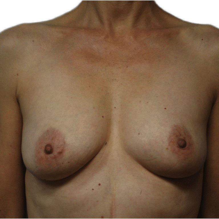 After Image: Fat Grafting to Breast with Liposuction - front
