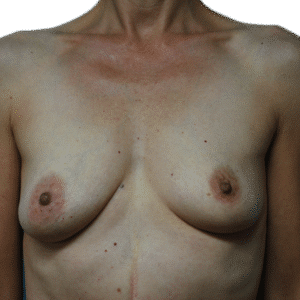 Before Image: Fat Grafting to Breast with Liposuction