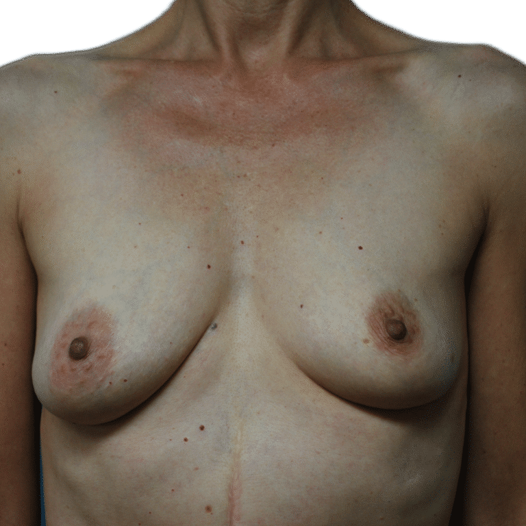 Before Image: Fat Grafting to Breast with Liposuction - front