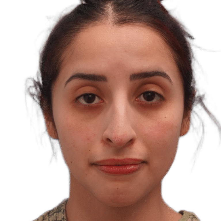 Before Image: Rhinoplasty - front