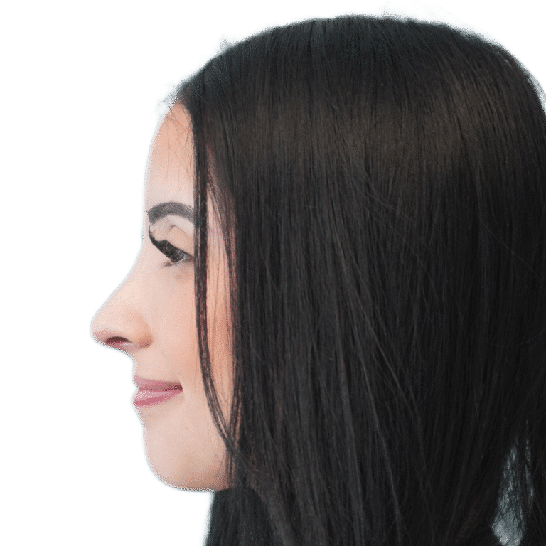 After Image: Rhinoplasty -