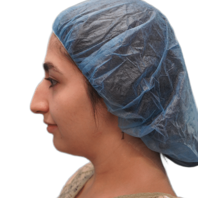 Before Image: Rhinoplasty -