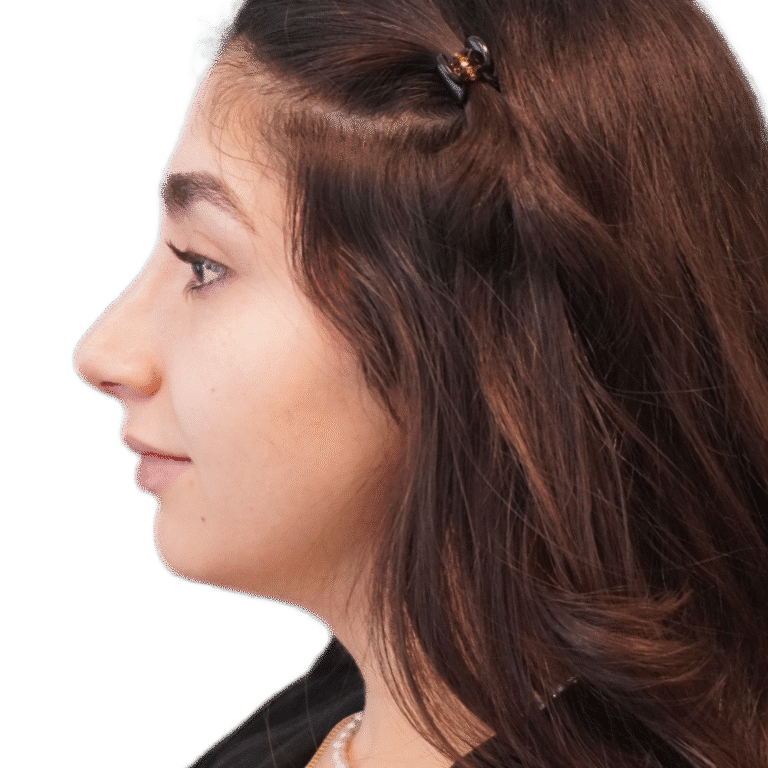 After Image: Rhinoplasty -