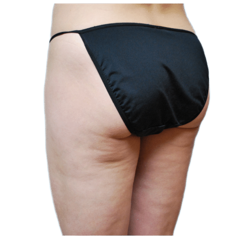 After Image: Fat Grafting to Breast with Liposuction - left-back-oblique