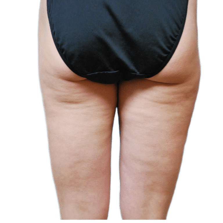 After Image: Fat Grafting to Breast with Liposuction -