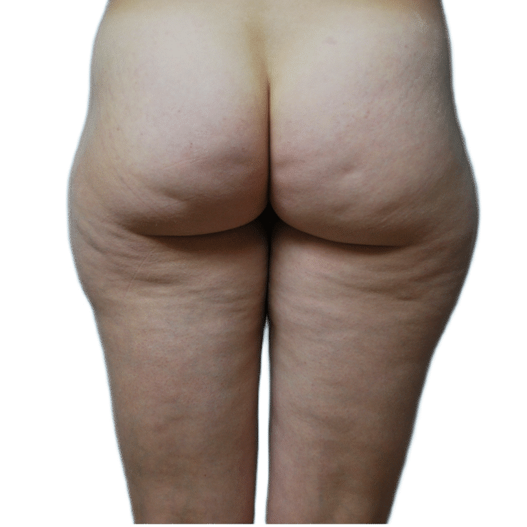 Before Image: Fat Grafting to Breast with Liposuction -