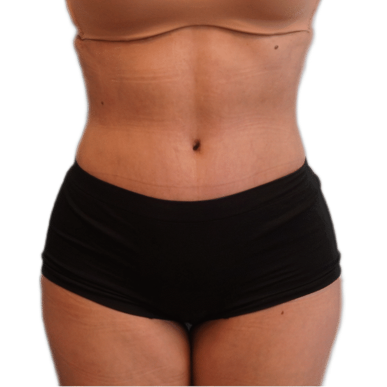 After Image: Tummy Tuck - front