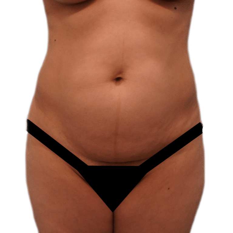 Before Image: Tummy Tuck - front