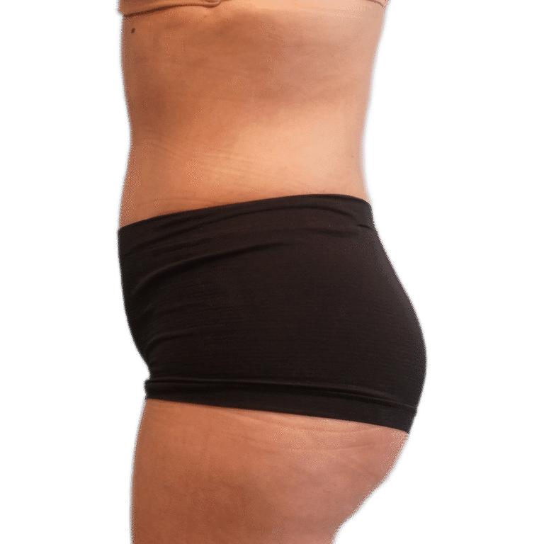 After Image: Tummy Tuck - left-front-oblique