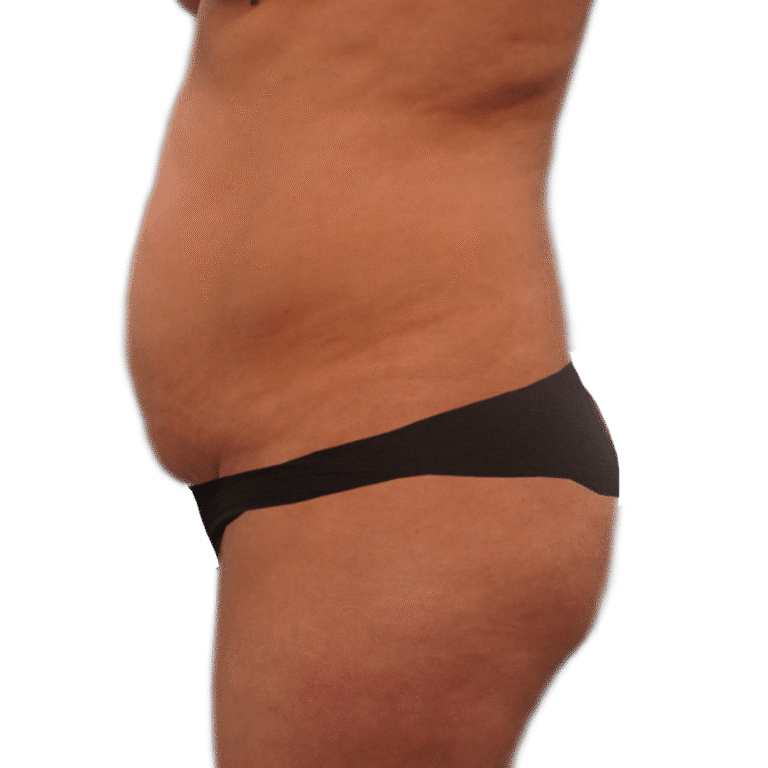 Before Image: Tummy Tuck - left-front-oblique