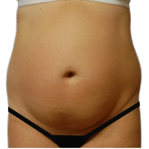 Before Image: Tummy Tuck