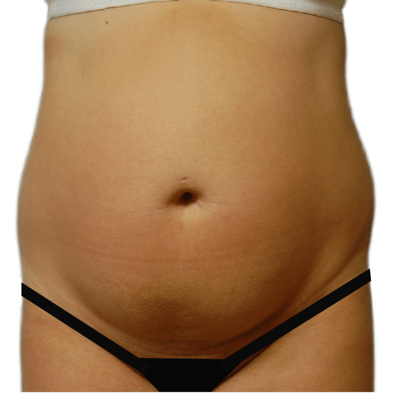 Before Image: Tummy Tuck - front
