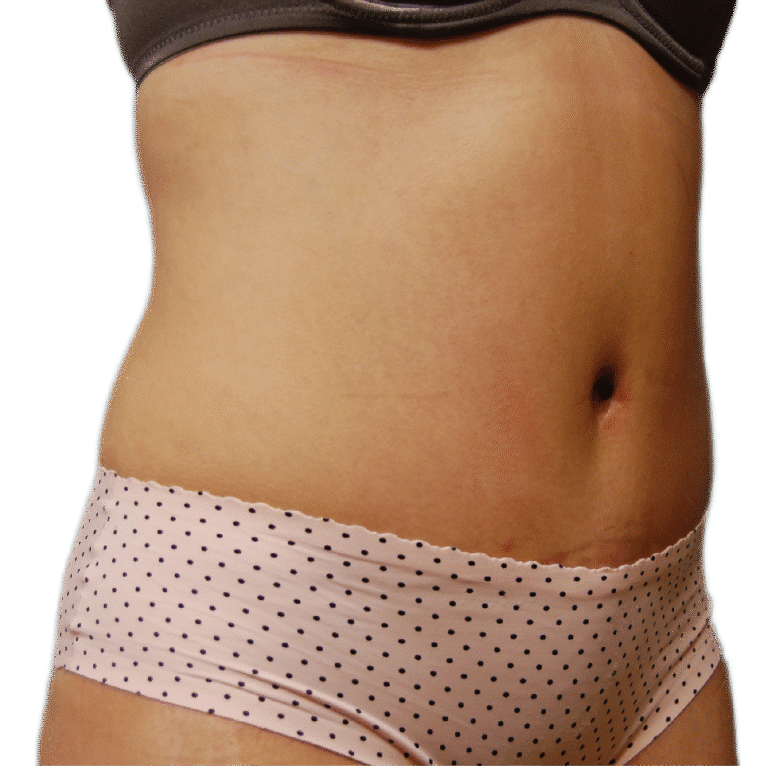 After Image: Tummy Tuck - right-front-oblique