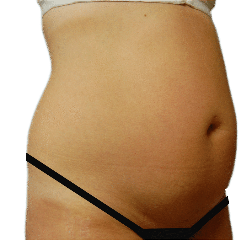 Before Image: Tummy Tuck - right-front-oblique