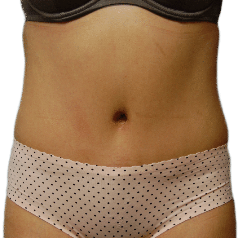 After Image: Tummy Tuck - front